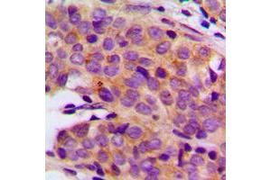 Immunohistochemical analysis of PRIM1 staining in human breast cancer formalin fixed paraffin embedded tissue section. (PRIM1 antibody  (C-Term))