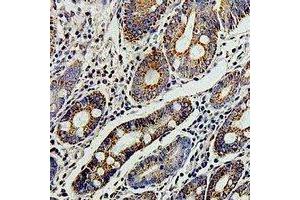 Immunohistochemical analysis of TERE1 staining in human colon cancer formalin fixed paraffin embedded tissue section. (UBIAD1 antibody)