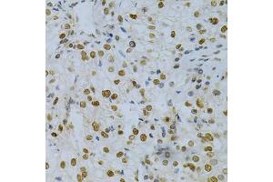 Immunohistochemistry of paraffin-embedded human kidney cancer using ELAVL1 Antibody (ABIN5970780) at dilution of 1/200 (40x lens). (ELAVL1 antibody)