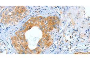 Immunohistochemistry of paraffin-embedded Human cervical cancer using ASNS Polyclonal Antibody at dilution of 1:60 (Asparagine Synthetase antibody)