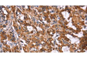 Immunohistochemistry of paraffin-embedded Human thyroid cancer tissue using HACE1 Polyclonal Antibody at dilution 1:40 (HACE1 antibody)