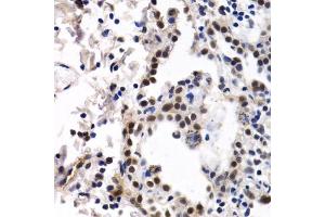Immunohistochemistry of paraffin-embedded human lung cancer using ID3 antibody (ABIN6130481, ABIN6142140, ABIN6142141 and ABIN6221020) at dilution of 1:200 (40x lens). (ID3 antibody  (AA 1-119))