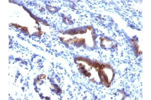 Formalin-fixed, paraffin-embedded human Gastric Carcinoma stained with MUC3 Mouse Monoclonal Antibody (M3. (MUC3A antibody)