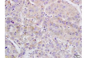 Formalin-fixed and paraffin embedded human brain glioma tissue labeled with Anti-Phospho-Wee1(Ser642) Polyclonal Antibody, Unconjugated (ABIN746873) at 1:200 followed by conjugation to the secondary antibody and DAB staining (WEE1 antibody  (pSer642))