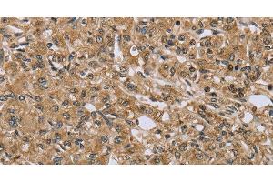 Immunohistochemistry of paraffin-embedded Human prostate cancer using TXLNA Polyclonal Antibody at dilution of 1:30 (alpha Taxilin antibody)