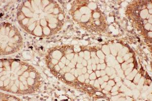 Anti-ALOX15 Picoband antibody,  IHC(P): Human Intestine Cancer Tissue (ALOX15 antibody  (AA 2-337))
