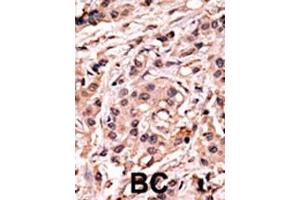 Immunohistochemistry (Paraffin-embedded Sections) (IHC (p)) image for anti-Tumor Protein P53 (TP53) (pSer20) antibody (ABIN389619)