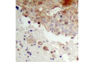 Immunohistochemical analysis of IKB epsilon (pS22) staining in human prostate cancer formalin fixed paraffin embedded tissue section.