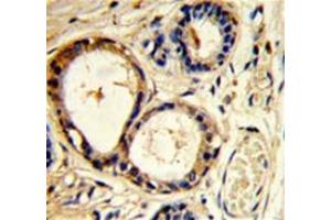 Immunohistochemistry analysis of human breast carcinoma (Formalin-fixed, Paraffin-embedded) using Cortactin (SRC8)  Antibody  (N-term), followed by  peroxidase-conjugated secondary antibody and DAB staining.