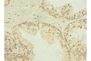 Immunohistochemistry of paraffin-embedded human prostate cancer using ABIN7170943 at dilution of 1:100 (Sulfide:quinone Oxidoreductase, Mitochondrial (SQOR) (AA 211-450) antibody)