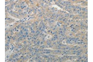 The image on the left is immunohistochemistry of paraffin-embedded Human ovarian cancer tissue using ABIN7131158(SPATA17 Antibody) at dilution 1/15, on the right is treated with fusion protein. (SPATA17 antibody)