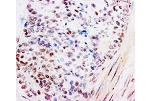 Immunohistochemistry with Glucocoticoid Receptor polyclonal antibody (Human mammary cancer). (Glucocorticoid Receptor antibody  (C-Term))