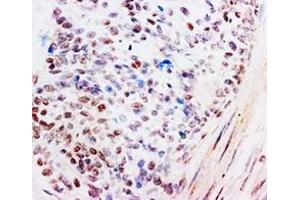 Immunohistochemistry with Glucocoticoid Receptor polyclonal antibody (Human mammary cancer).