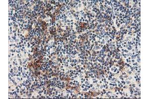 Immunohistochemical staining of paraffin-embedded Human lymphoma tissue using anti-NAPEPLD mouse monoclonal antibody. (NAPEPLD antibody)