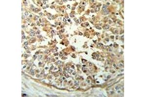 STING antibody IHC analysis in formalin fixed and paraffin embedded breast carcinoma. (STING/TMEM173 antibody  (AA 311-340))