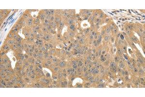 Immunohistochemistry of paraffin-embedded Human ovarian cancer using STX1A Polyclonal Antibody at dilution of 1:40 (STX1A antibody)