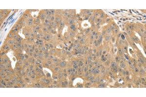 Immunohistochemistry of paraffin-embedded Human ovarian cancer using STX1A Polyclonal Antibody at dilution of 1:40 (STX1A antibody)