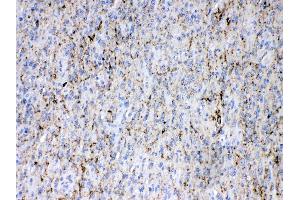 Synapsin I was detected in paraffin-embedded sections of human glioma tissues using rabbit anti- Synapsin I Antigen Affinity purified polyclonal antibody (Catalog # ) at 1 ? (SYN1 antibody  (C-Term))