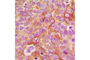 Immunohistochemical analysis of GABRB1 (pS434) staining in human breast cancer formalin fixed paraffin embedded tissue section. (GABRB1 antibody  (C-Term, pSer434))