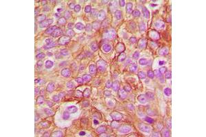 Immunohistochemical analysis of GABRB1 (pS434) staining in human breast cancer formalin fixed paraffin embedded tissue section.