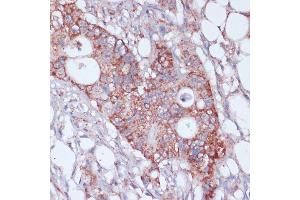 Immunohistochemistry of paraffin-embedded human colon carcinoma using MRPL23 antibody (ABIN7268564) at dilution of 1:100 (40x lens).