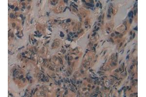 DAB staining on IHC-P; Samples: Human Breast cancer Tissue (Fibrillin 2 antibody  (AA 1550-1791))