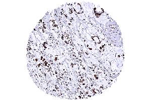 Gastric adenocarcinoma diffuse type with intense nuclear TRIM28 immunostaining of tumor cells