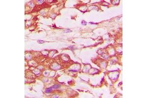 Immunohistochemical analysis of CD120b staining in human lung cancer formalin fixed paraffin embedded tissue section. (TNFRSF1B antibody  (C-Term))