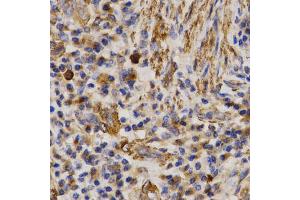 Immunohistochemistry of paraffin-embedded human lung cancer using MMP25 antibody (ABIN5971552) at dilution of 1/200 (40x lens). (MMP25 antibody)