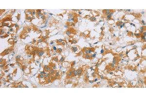 Immunohistochemistry of paraffin-embedded Human thyroid cancer using CYP2E1 Polyclonal Antibody at dilution of 1:35 (CYP2E1 antibody)