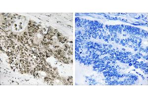 Peptide - +Immunohistochemistry analysis of paraffin-embedded human colon carcinoma tissue using ATR antibody. (ATR antibody  (N-Term))
