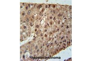 ZC4H2 Antibody (C-term) immunohistochemistry analysis in formalin fixed and paraffin embedded human hepatocarcinoma followed by peroxidase conjugation of the secondary antibody and DAB staining. (ZC4H2 antibody  (C-Term))