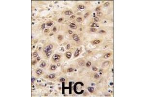 Formalin-fixed and paraffin-embedded human hepatocarcinoma tissue reacted with GNL3 antibody (C-term), which was peroxidase-conjugated to the secondary antibody, followed by DAB staining.