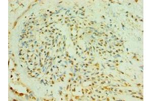 Immunohistochemistry of paraffin-embedded human breast cancer using ABIN7174009 at dilution of 1:100 (BLK antibody  (AA 1-280))