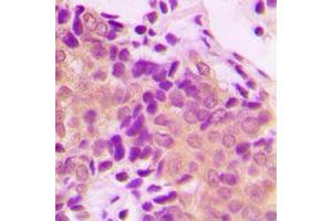 Immunohistochemical analysis of ACTN1/2/3/4 staining in human breast cancer formalin fixed paraffin embedded tissue section. (ACTN1/2/3/4 antibody  (N-Term))