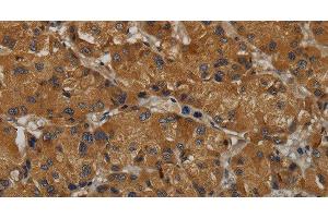 Immunohistochemistry of paraffin-embedded Human liver cancer tissue using MAS1 Polyclonal Antibody at dilution 1:50 (MAS1 antibody)