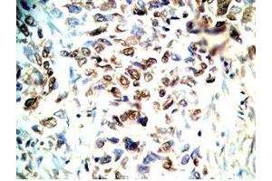Human lung cancer tissue stained by Rabbit Anti-CRAMP(140-173) (Mouse) Antibody (Cathelicidin antibody  (AA 140-173))