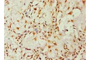 Immunohistochemistry of paraffin-embedded human breast cancer using ABIN7143676 at dilution of 1:100 (ALDH1B1 antibody  (AA 278-517))