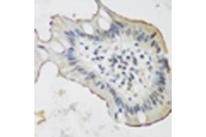 Immunohistochemistry of paraffin-embedded human stomach cancer using ALOX15 antibody (ABIN5975430) at dilution of 1/200 (40x lens). (ALOX15 antibody)