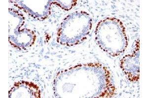 IHC testing of FFPE human prostate cancer with p40 antibody. (p40 (p63 Delta) (AA 5-17) antibody)