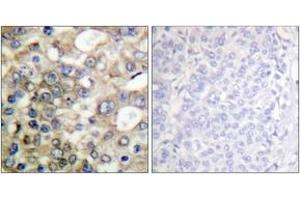 Immunohistochemistry analysis of paraffin-embedded human breast carcinoma tissue, using BTK (Ab-222) Antibody. (BTK antibody  (AA 188-237))
