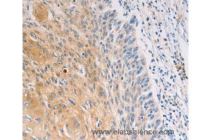 Immunohistochemistry of Human breast cancer using MUC5B Polyclonal Antibody at dilution of 1:30 (MUC5B antibody)