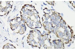 Immunohistochemistry of paraffin-embedded Human breast cancer using WASF3 Polyclonal Antibody at dilution of 1:100 (40x lens). (WASF3 antibody)