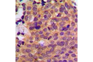 Immunohistochemical analysis of CK1 alpha staining in human breast cancer formalin fixed paraffin embedded tissue section. (CSNK1A1 antibody  (Center))