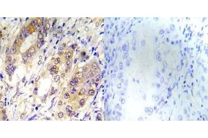 Immunohistochemical analysis of paraffin-embedded human lung carcinoma tissue using Tsc2 (phospho-Thr1462) antibody (E012050). (Tuberin antibody  (pThr1462))