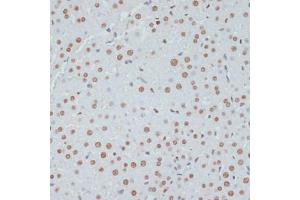 Immunohistochemistry (IHC) image for anti-Tumor Protein P53 (TP53) (pSer33) antibody (ABIN6136276)