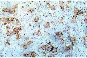 Immunohistochemistry (IHC) analyzes of EGFR pAb in paraffin-embedded human breast carcinoma tissue. (EGFR antibody)