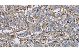 Immunohistochemistry of paraffin-embedded Human liver cancer using CD32 Polyclonal Antibody at dilution of 1:40 (Fc gamma RII (CD32) antibody)