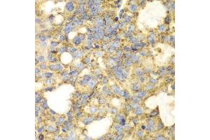 Immunohistochemistry of paraffin-embedded human oophoroma using SOD2 antibody. (SOD2 antibody  (AA 25-222))