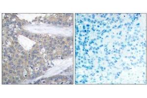 Immunohistochemical analysis of paraffin-embedded human breast carcinoma tissue using Paxillin (Ab-31) antibody (E021199). (Paxillin antibody)